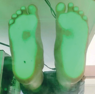 Obr. 4 Plantoskopický nález B3, již přítomna konvexní mediální prominence okraje nohy.