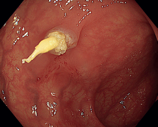Obr. 4 Stopka polypu po&nbsp;endoskopické polypektomii v&nbsp;bílém světle.