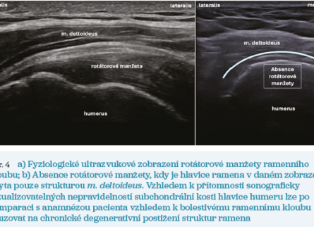 Obr. 4 Ultrazvukové zobrazení rotátorové manžety