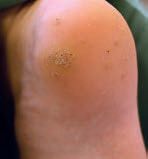 Obr. 4 Verruca plantaris.
