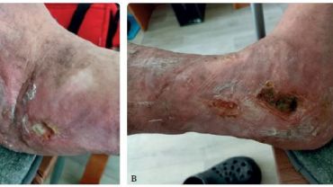 Obr. 4A, B Defekty po druhé hospitalizaci a delším pobytu v LDN Obr. 4A, B Defekty po druhé hospitalizaci a delším pobytu v LDN