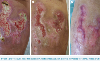 Obr. 5–7 Použití HydroCleanu a&nbsp;následně HydroTacu