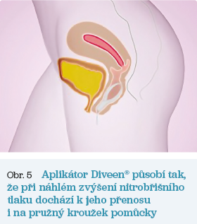 Obr. 5 Aplikátor Diveen®
