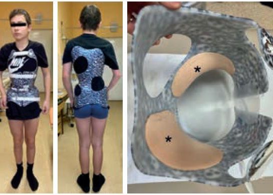 Obr. 5 Čtrnáctiletý pacient s&nbsp;aplikovaným TLSO korzetem z&nbsp;prefabrikované skořepiny s&nbsp;pelotami k&nbsp;dosažení maximální korekce křivky. 