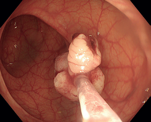 Obr. 5 Extrakce resekátu stopkatého polypu.