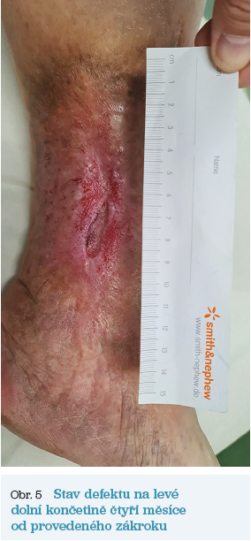 Obr. 5 Stav defektu čtyři měsíce od&nbsp;zákroku