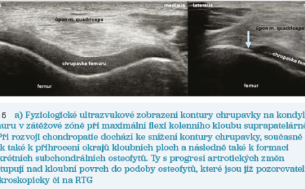 Obr. 5 Ultrazvukové zobrazení kontury chrupavky