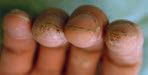 Obr. 5 Verrucae periungualis.