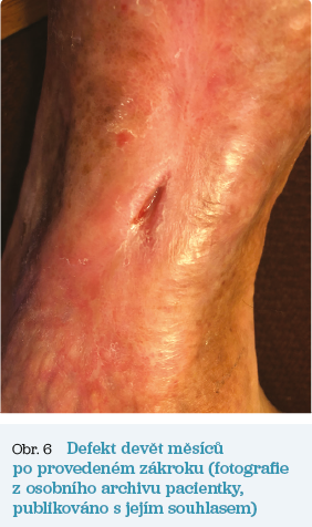 Obr. 6 Defekt devět měsíců po&nbsp;provedení zákroku