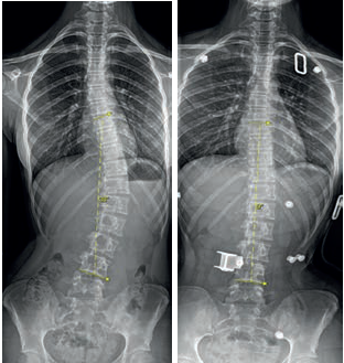 Obr. 6 Snímky čtrnáctileté dívky s&nbsp;levostrannou thorakolumbální skoliózou. 