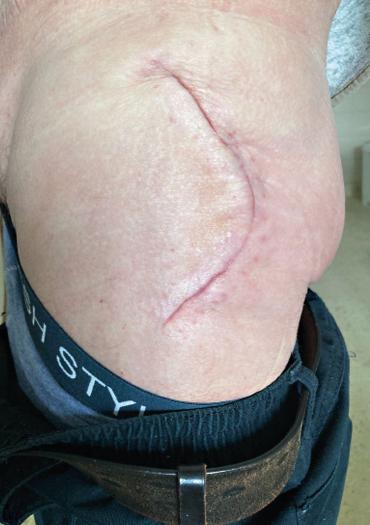 Obr. 6 Zhojená rána po&nbsp;čtyřech týdnech.