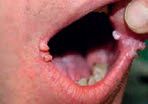Obr. 7 Verrucae oris.