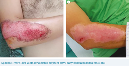 Obr. 8 a&nbsp;9 Aplikace HydroTacu