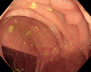 Obr. 8 Drobná léze 0‑IIa v&nbsp;transverzu.