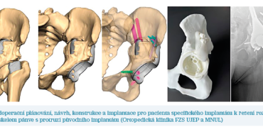 Obr. 8 Předoperační plánování, návrh, konstrukce a implantace pro pacienta specifického implantátu Obr. 8 Předoperační plánování, návrh, konstrukce a implantace pro pacienta specifického implantátu