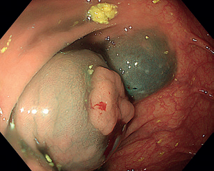 Obr. 9 Elevace léze po&nbsp;submukózní injekci.