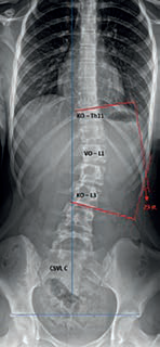 Obr. 1 Thorakolumbální skolióza Lenke typ 5 (Th11 – 23 sin. – L3), CSVL C&nbsp;– křivka tedy&nbsp;vykazuje abnormalitu ve&nbsp;frontální rovnováze. KO = koncový obratel; VO = vrcholový obratel. Horizontální linie procházející stříškami pánevních acetabul vylučuje asymetrii výšek kyčelních kloubů. Zdroj: Ortopedická klinika FZS UJEP a&nbsp;MN UL.
