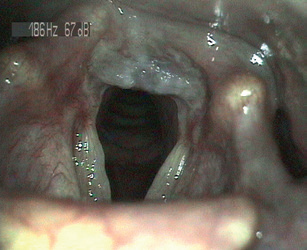 Obr. 2 Nález charakteristický pro&nbsp;EERCH – nápadné poškození sliznice hrtanu – edém v&nbsp;arytenoidní krajině, hustý hlen, obliterace ventriculus laryngis. EERCH – mimojícnová refluxní choroba jícnu (extraezofageální refluxní choroba)
