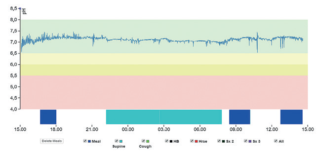 Obr. 3 Normální záznam 24hodinové monitorace orofaryngeálního pH: hodnoty pH se po celou dobu měření pohybují v rozmezí 6,5–7,5. Neprokazuje EERCH. EERCH – mimojícnová refluxní choroba jícnu (extraezofageální refluxní choroba) Obr. 3 Normální záznam 24hodinové monitorace orofaryngeálního pH: hodnoty pH se po celou dobu měření pohybují v rozmezí 6,5–7,5. Neprokazuje EERCH. EERCH – mimojícnová refluxní choroba jícnu (extraezofageální refluxní choroba)