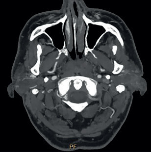Obr. 4 Retrográdní tok v&nbsp;levé AV dosahoval až do&nbsp;horizontálního extrakraniálního úseku vertebrální arterie V3 vlevo v&nbsp;oblasti oblouku prvního krčního obratle C1 (šipka). AV – arteria vertebralis