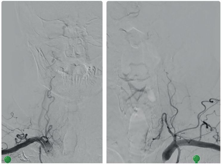Obr. 2 Uzávěr arteria vertebralis (AV) vpravo a&nbsp;uzávěr AV vlevo v&nbsp;odstupu.