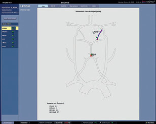Obr. 5 Kvantitativní MR angiografie (QMRA) prokázala retrográdní tok v&nbsp;levé zadní komunikantě 30 ml/min a&nbsp;sotva detekovatelný retrográdní tok v&nbsp;bazilární arterii 17 ml/min (fyziologický tok by měl být 120 ml/min).