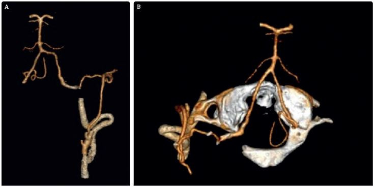 Obr. 8A–B&nbsp;Pooperační CTA dobře patentního bypassu. CTA ukazuje průtok z&nbsp;povodí a. carotis externa cestou a. occipitalis do&nbsp;levé a. vertebralis a&nbsp;celého vertebrobazilárního povodí (místo&nbsp;anastomózy označeno červeným kruhem). CTA – výpočetní tomografie – angiografie