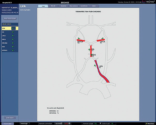 Obr. 9 Kvantitativní MR angiografie (QMRA): Pooperační vyšetření QMRA ukazuje obnovený antegrádní tok v&nbsp;levé arteria vertebralis 60 ml/min, antegrádní tok v&nbsp;a. bazilaris a&nbsp;fyziologický průtok v&nbsp;zadních mozkových tepnách (levá LPCA 44 ml/min, pravá RPCA 59 ml/min).