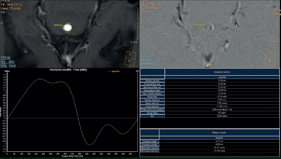 Obr. 4 PC‑MRI sekvence zaměřená na kvantifikaci průtokových parametrů likvoru. PC‑MRI – zobrazování magnetickou rezonancí s fázovým kontrastem (phase contrast magnetic resonance imaging) Obr. 4 PC‑MRI sekvence zaměřená na kvantifikaci průtokových parametrů likvoru. PC‑MRI – zobrazování magnetickou rezonancí s fázovým kontrastem (phase contrast magnetic resonance imaging)