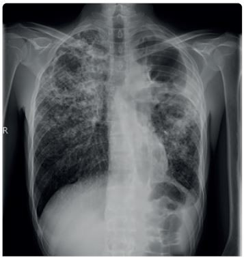Obr. 2 Radiologický nález pacienta s&nbsp;MDR/RR TB. Rozsáhlý oboustranný radiologický nález, kaverny v&nbsp;obou plicních vrcholech (archiv autora) MDR/RR TB – multirezistentní, resp. rifampicin rezistentní tuberkulóza