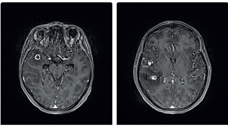 Obr. 3 Magnetická rezonance CNS. Postižení mozku tuberkulomy. Pacientka léčená přípravky anti‑TNF pro&nbsp;psoriázu s&nbsp;diagnózou TB plic, pleury a&nbsp;CNS (archiv autorky) CNS – centrální nervový systém; TNFα – tumor nekrotizující faktor alfa; TB – tuberkulóza