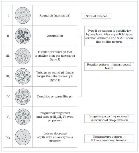 Obr. 2 Kudova „pit pattern” klasifikace využívající kombinaci chromoendoskopie a&nbsp;zvětšovací endoskopie k&nbsp;popisu uspořádání ústí krypt v&nbsp;závislosti na&nbsp;biologickém chování léze Převzato z: Tanaka S, et al. High‑magnification colonoscopy (with videos). Gastrointest Endosc 2006;64:604–613. doi:10.1016/j.gie.2006.06.007