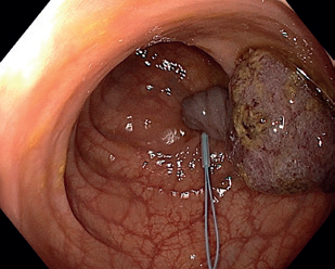 Obr. 6 Stahovací smyčka (endoloop) nasazená na&nbsp;stopce objemného polypu působící jeho ischemizaci.