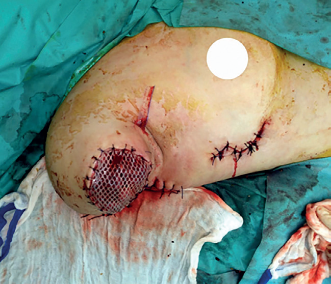 Obr. 1 Uzávěr pahýlu s&nbsp;preventivním použitím podtlakové terapie ran (NPWT) pro&nbsp;fixaci a&nbsp;přihojení síťky MESH Foto: archiv autorky