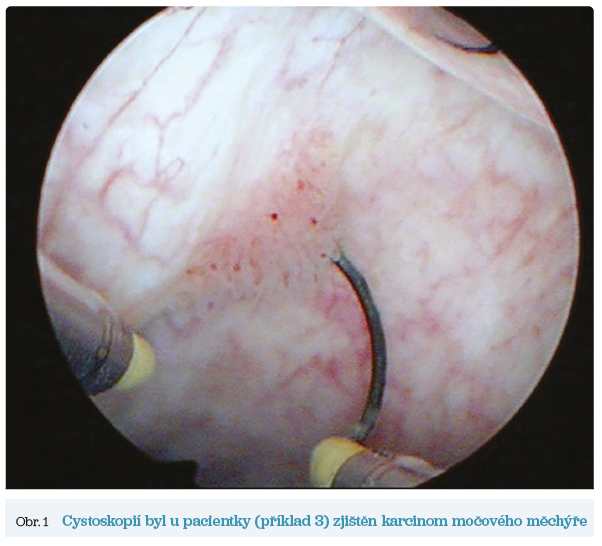 Obr. 1 Cystoskopií byl u&nbsp;pacientky (příklad 3) zjištěn karcinom močového měchýře