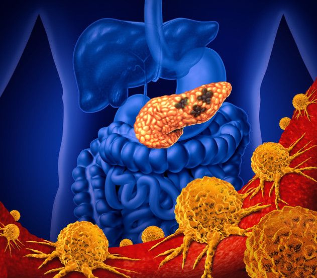 karcinom slinivka pankreas