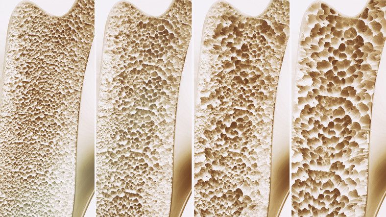 Osteoporoza