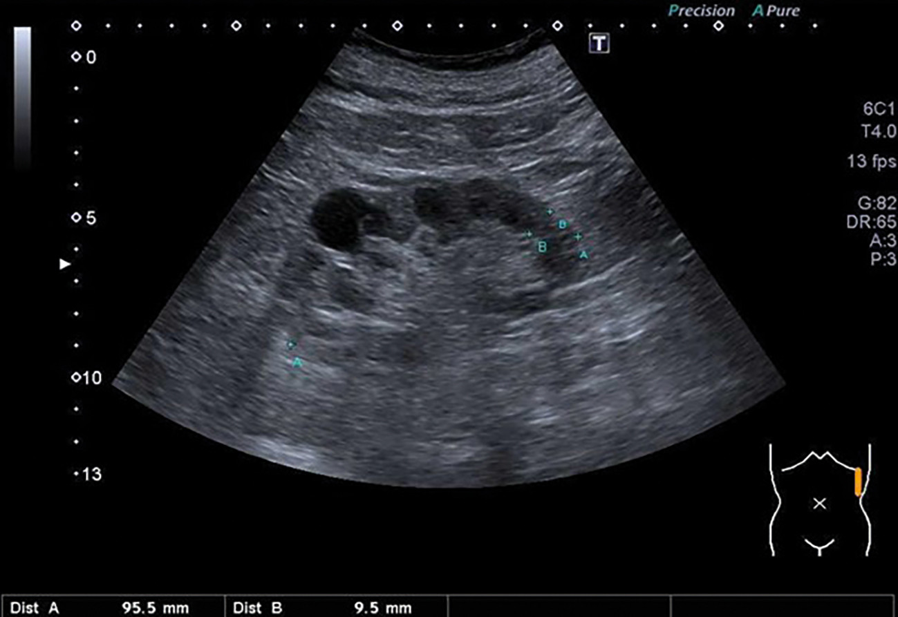 Obr. 2 Známky chronické nefropatie v&nbsp;UZ zobrazení. Redukovaná šíře parenchymu (kortikomedulární tloušťka), zvýšená echogenita ledviny. Zachycena je také renální cysta UZ – ultrazvuk