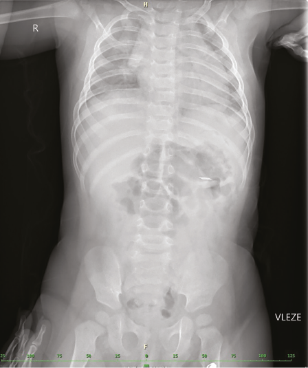 Hlavním rizikem je nebezpečí poškození trávicího traktu (rtg snímek) Hlavním rizikem je nebezpečí poškození trávicího traktu (rtg snímek)