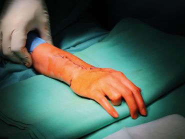 Ruka pacientky po voperování implantátu Ruka pacientky po voperování implantátu